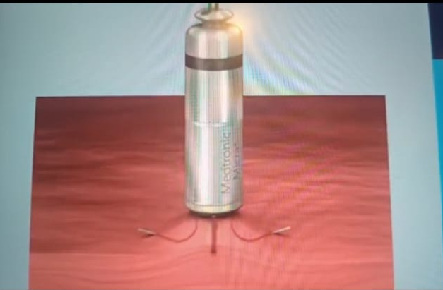 implant